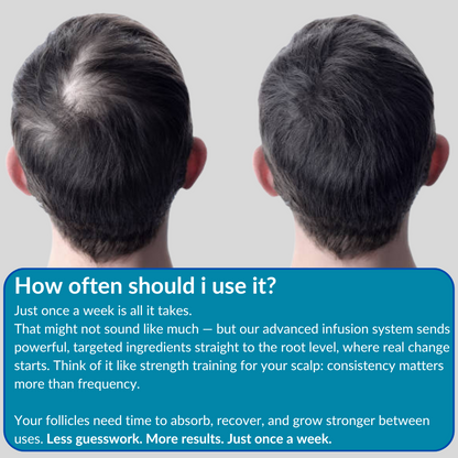 Alphafuse - Infusion Hair Regrowth Kit