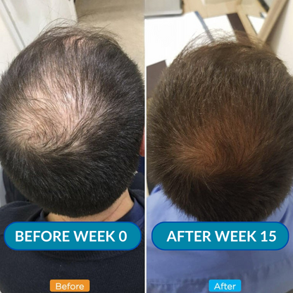 Alphafuse - Infusion Hair Regrowth Kit